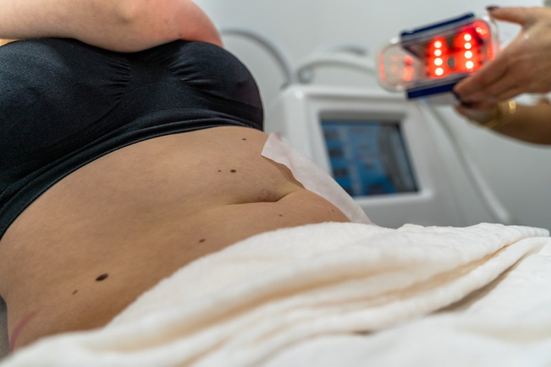 Cryolipolyse behandeling - Lipo Beauty