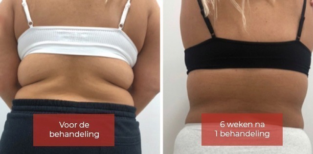 Result Cryolipolysis: before and after photo Rug