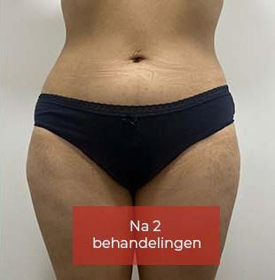 Lipo_Beauty_Cryolipolyse_na_1