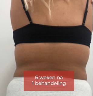 Lipo_Beauty_Cryolipolyse_na_4