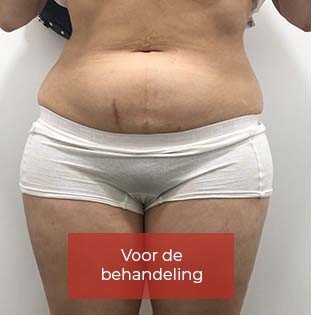 Lipo_Beauty_Cryolipolyse_voor_1