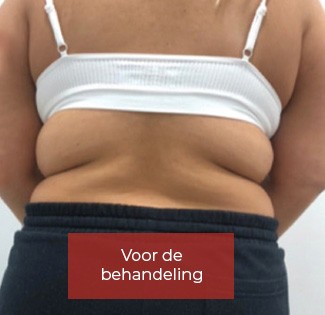 Lipo_Beauty_Cryolipolyse_voor_4