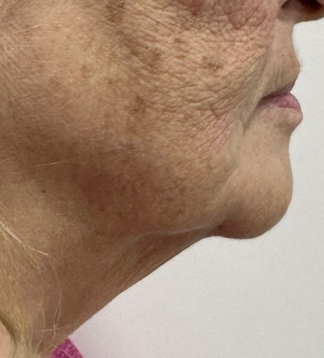 Lipo_Beauty_HIFU_after_1