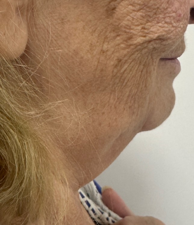Lipo_Beauty_HIFU_before_1