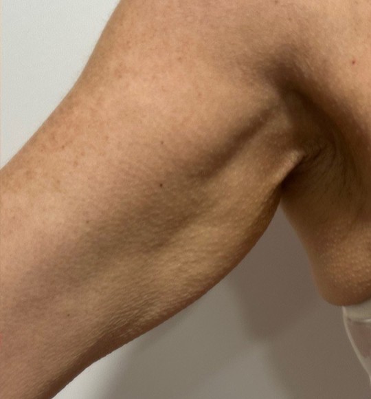 Lipo_Beauty_HIFU_na_2