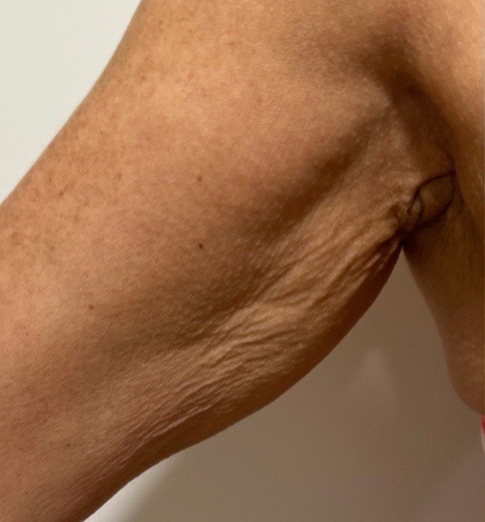 Lipo_Beauty_HIFU_voor_2
