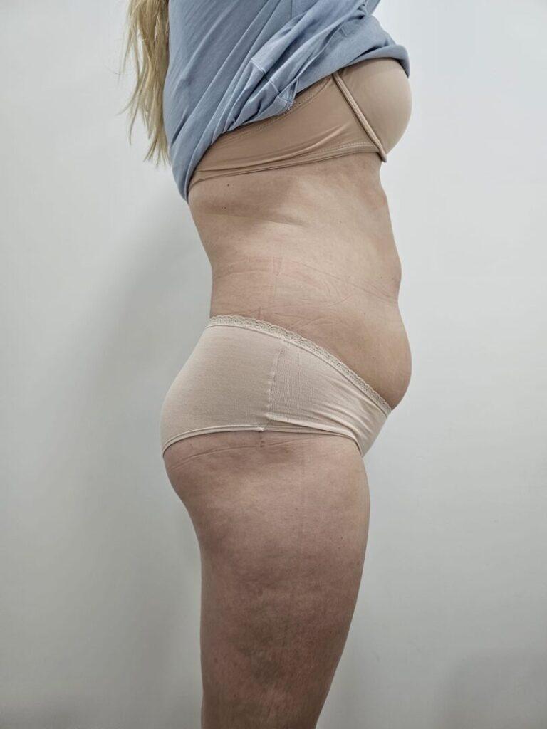 Lipo Beauty_Cryolipolyse_na_10