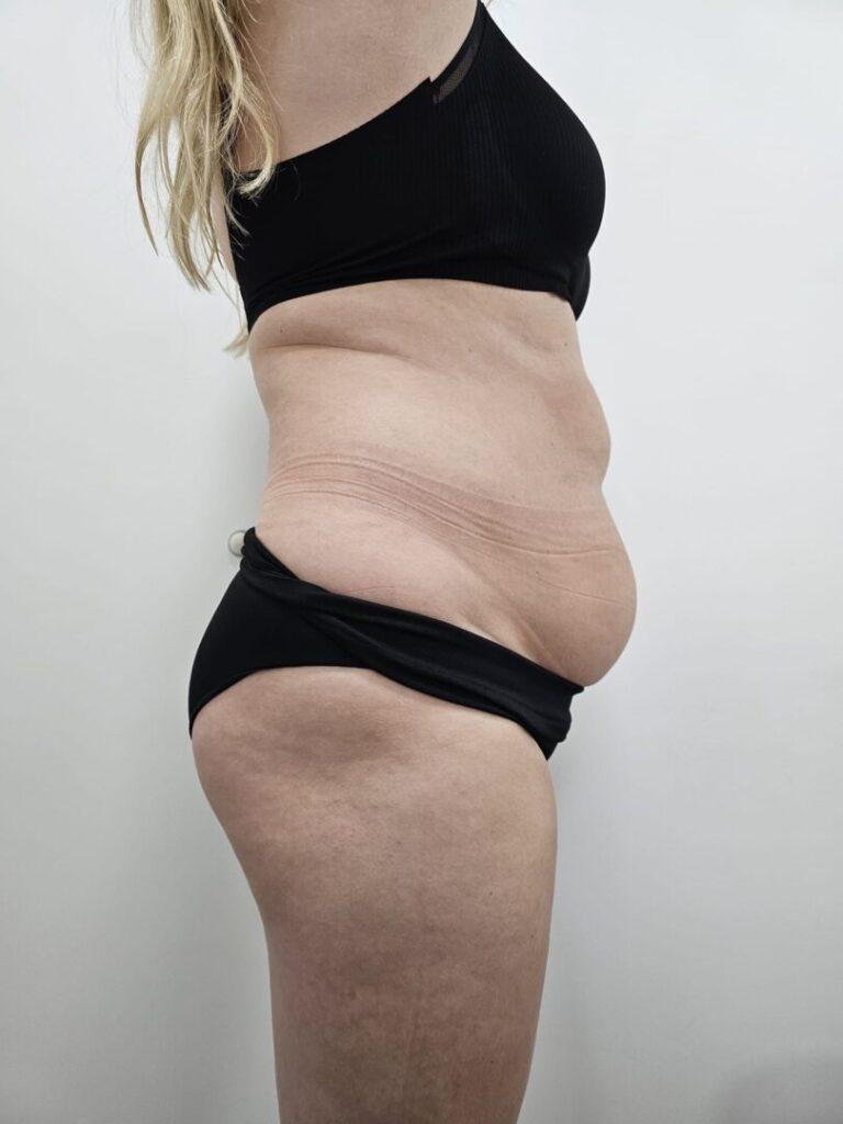 Lipo Beauty_Cryolipolyse_voor_10