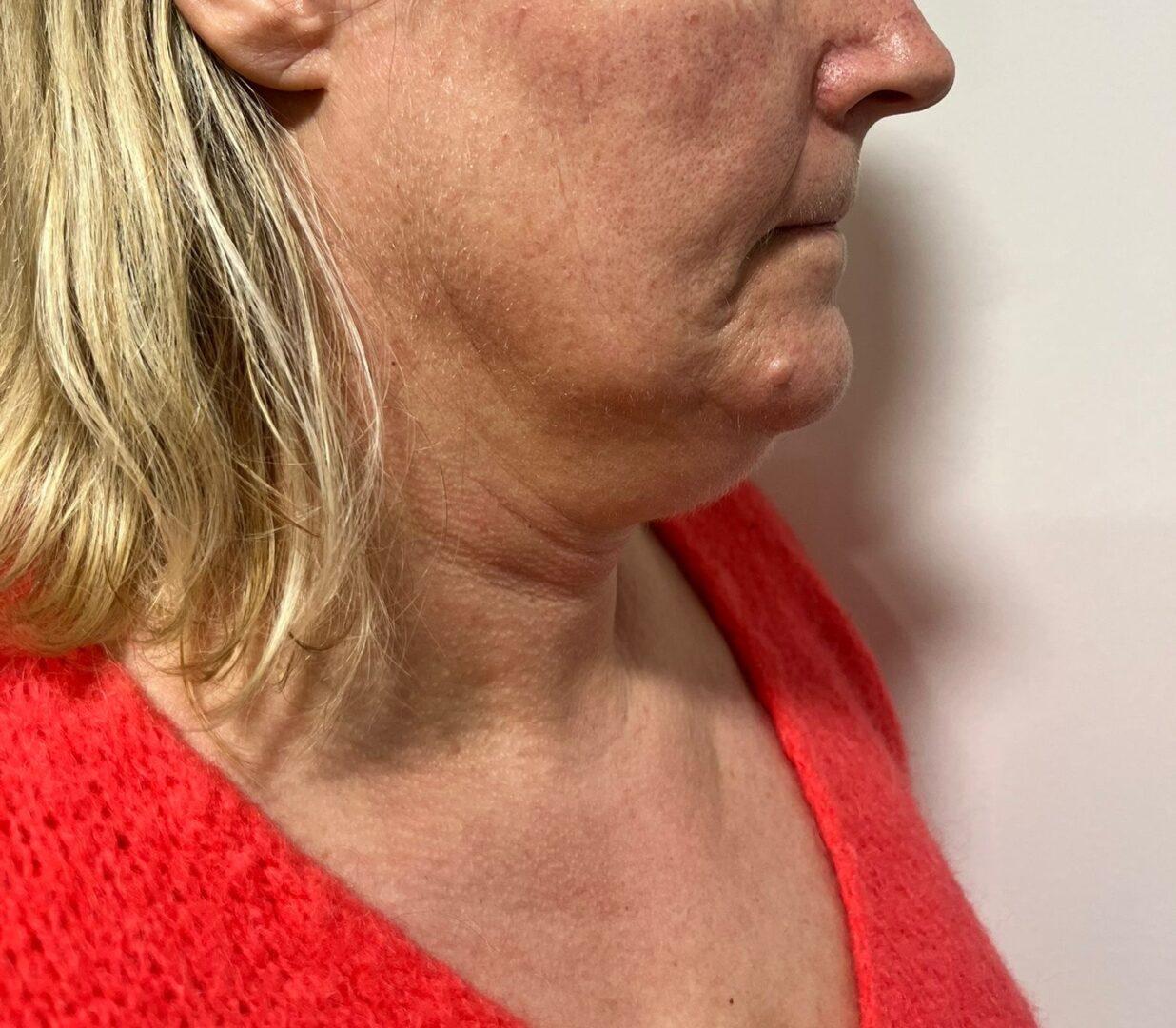 Lipo Beauty_HIFU_VOOR_14