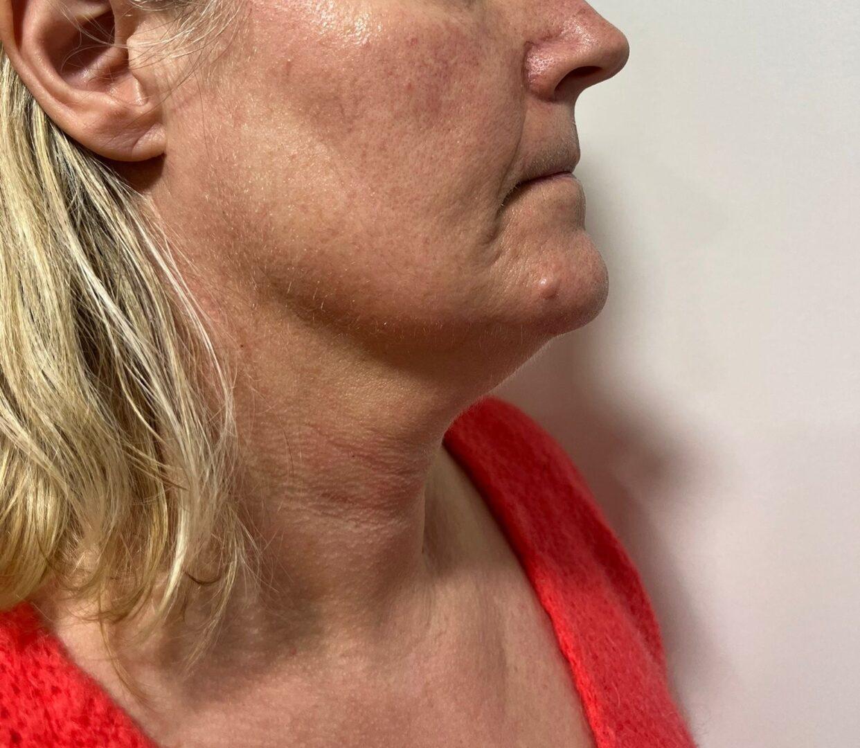 Lipo Beauty_HIFU_na_11